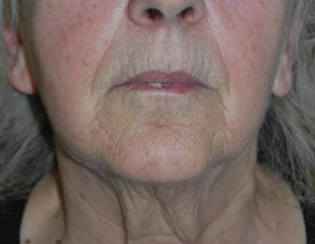 FaceTite 7 before