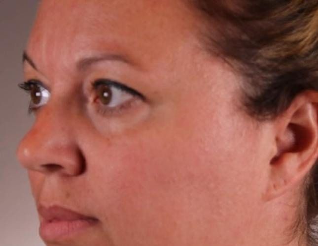 FaceTite 8 before