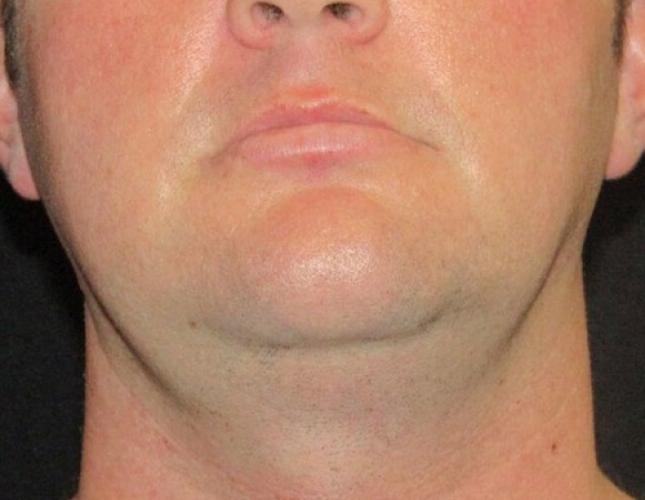 FaceTite 9 before