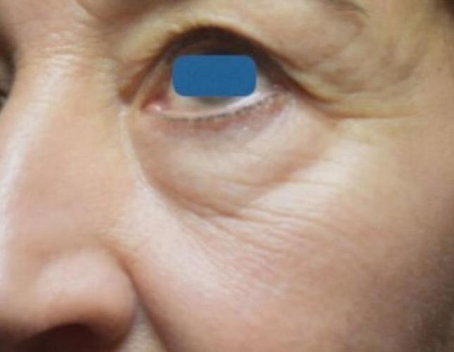 Morpheus8 7 before