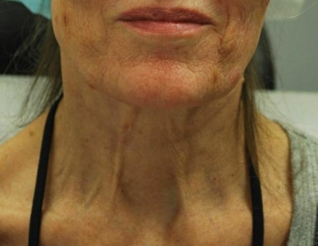 Morpheus8 1 before