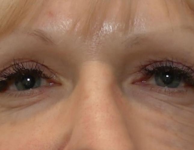 Morpheus8 2 after