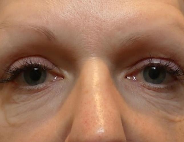 Morpheus8 2 before