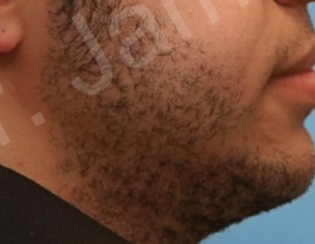 Orthognathic Surgery 3 after