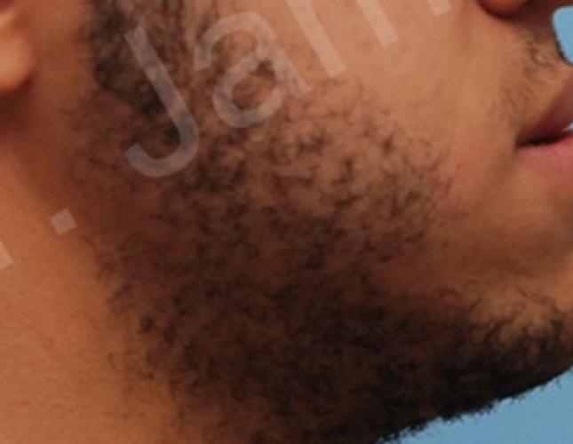 Orthognathic Surgery 3 before