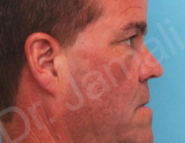 Orthognathic Surgery 4 before