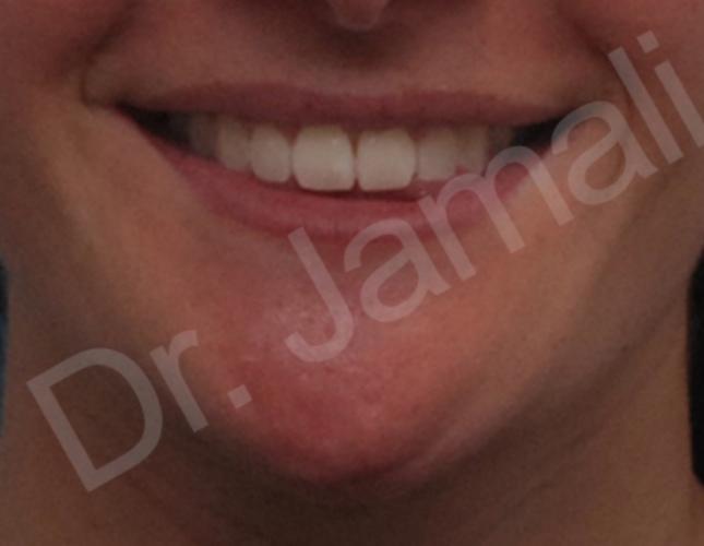 Orthognathic Surgery 5 after