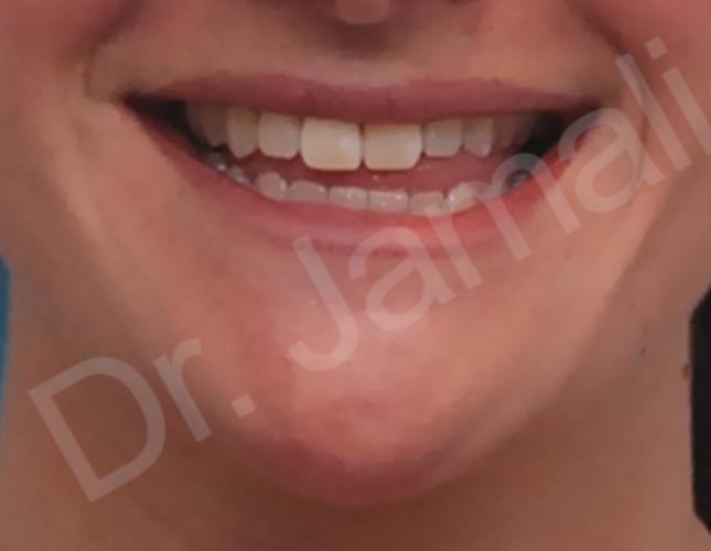 Orthognathic Surgery 5 before
