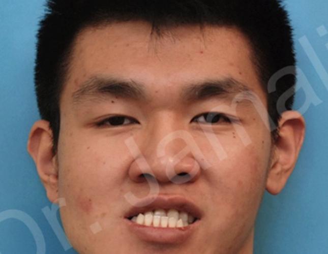 Orthognathic Surgery full before
