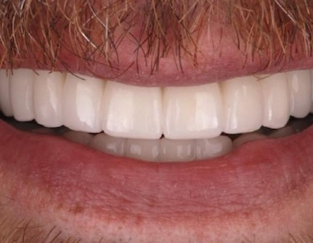 Dental implants 1 after Dental implants 1 after