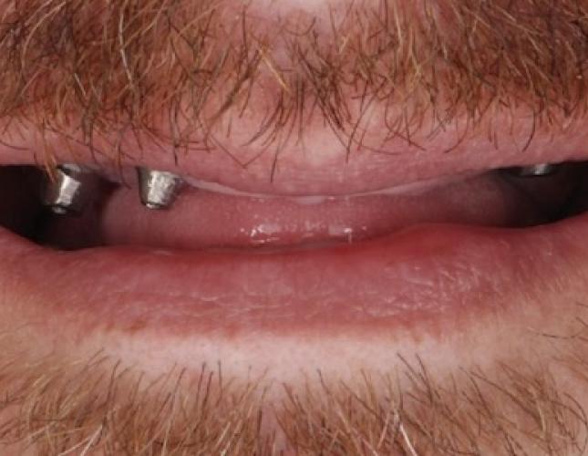 Dental implant before Dental implant before
