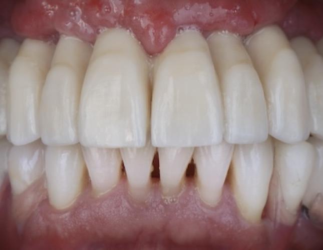 Implants 2 after Implants 2 after
