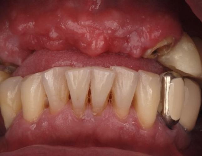 Implants 2 before Implants 2 before