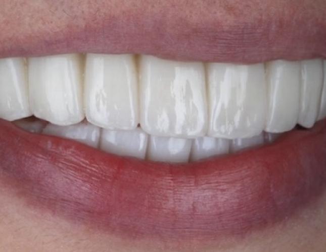 Implants 3 after