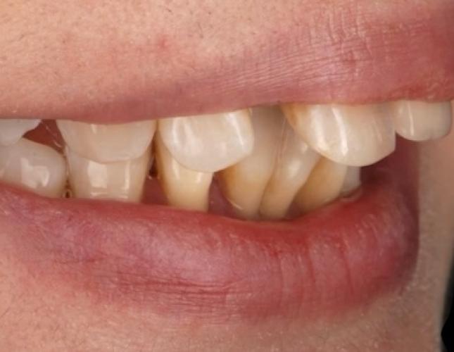 Implants 3 before
