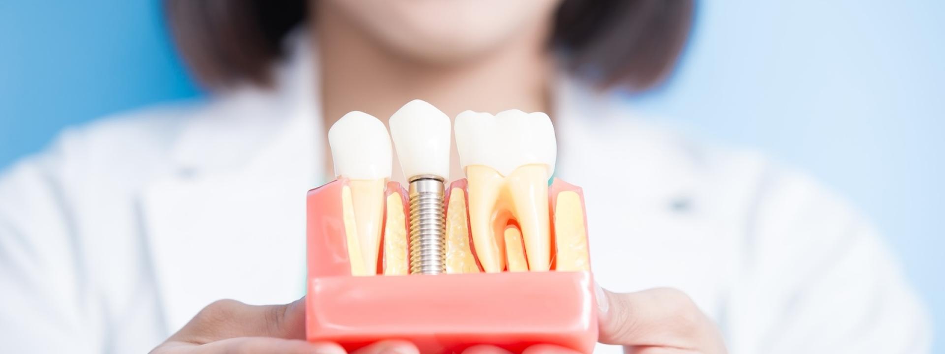 Dental implants